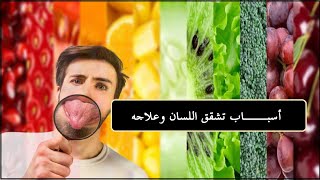 أسباب تشقق اللسان وعلاجه ضياء تيوب   Diyaa Tube