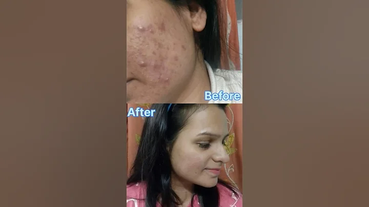 acne journey 🫶🥺 #shorts #acne #acnejourney #acneproneskin #acnetreatment #skincare #darkspots