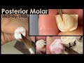 Making a Posterior Molar: Step-By-Step