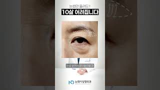 눈썹만 올렸을 뿐인데? 결과가 확 달라진다고?  3가지 얼굴 유형 바로 알려 줄께 #중년성형 #눈썹하거상