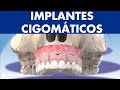 Implantes CIGOMÁTICOS - Cómo colocar implantes a pacientes con poco hueso ©