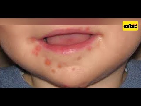 infección viral en el pie