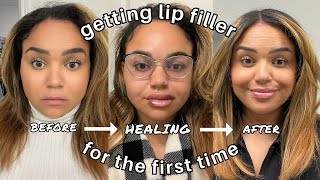 LIP FILLER VLOG *my FIRST time* // The appointment, FULL healing process + my overall experience by Keisha Pettway 486 views 3 months ago 20 minutes