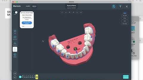 Automatic clear aligner trimming