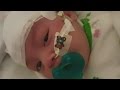 Meet the First Baby Ever Treated with Cannabis CBD Oil at The Hospital