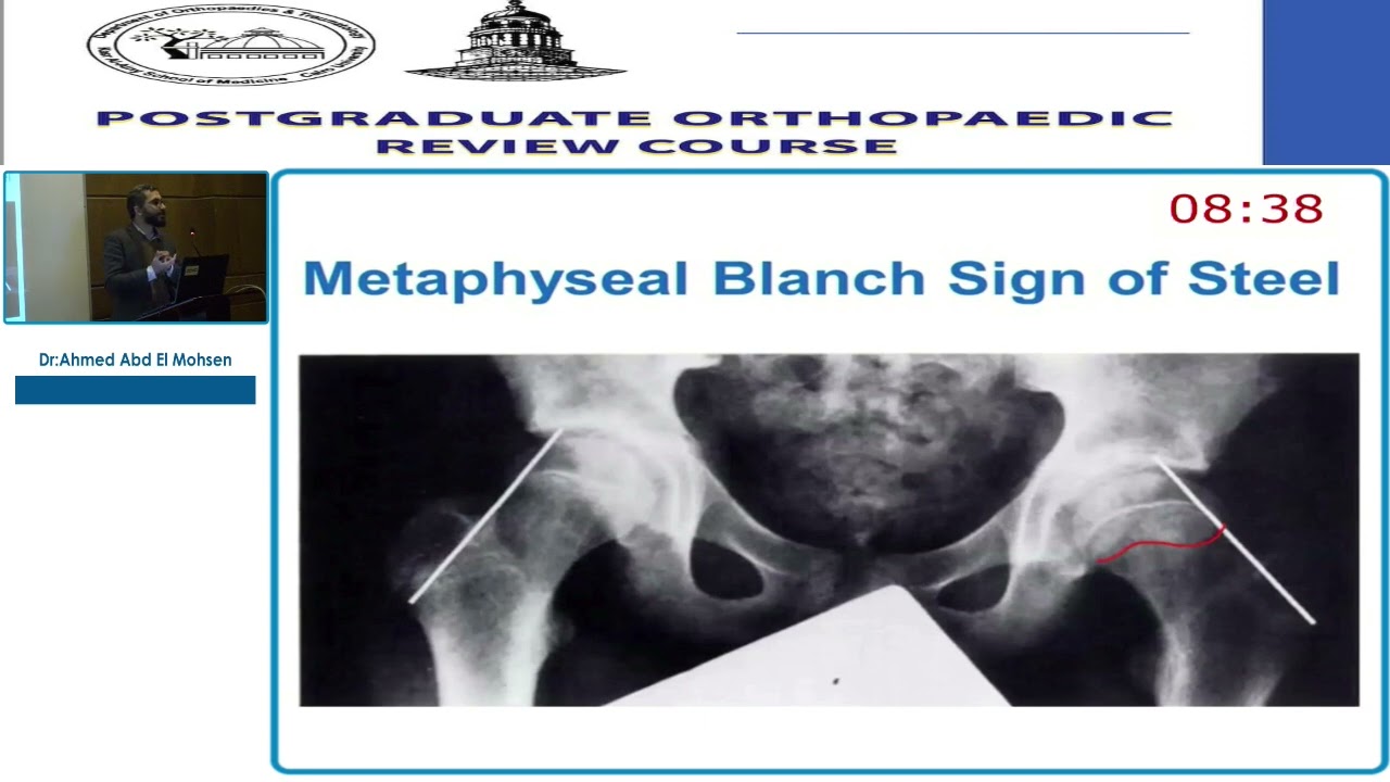 13 Slipped Capital Femoral Epiphysis   Ahmed Abd EL Mohsen