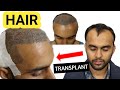 Amazing Hair Transplant in India 2020 || Hair Transplant Clinic, Result in India