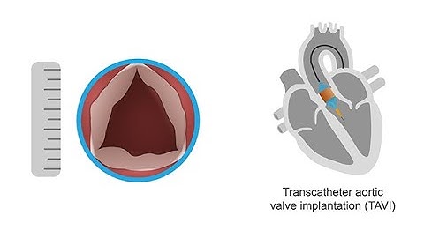 Evaluating the aortic valve using 3D echocardiography