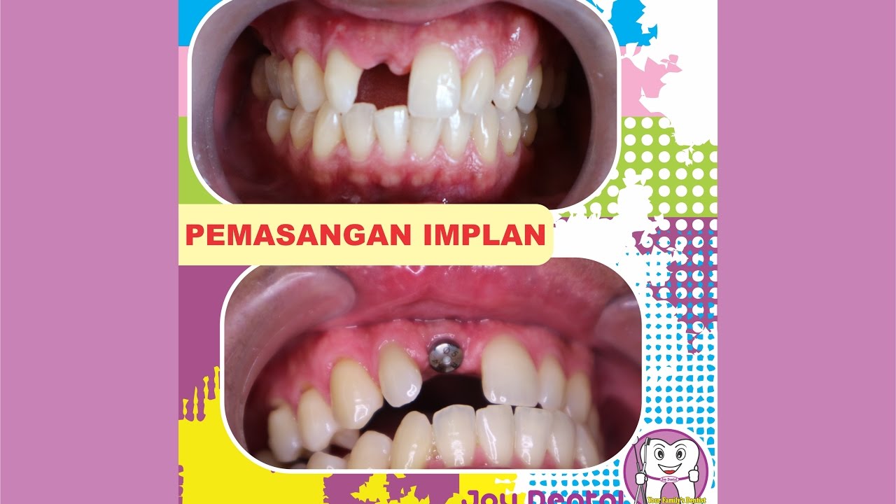 Pemasangan Implan Gigi  di Klinik Gigi  Joy Dental Gigi  