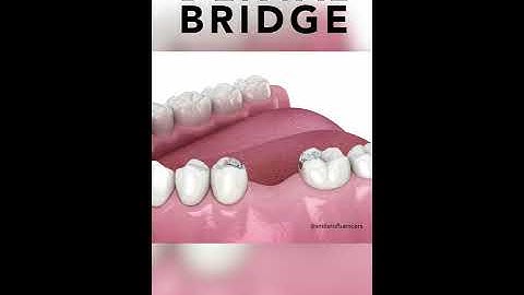 Dental Bridge #shorts