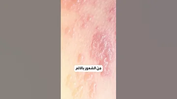 أعراض وأسباب الحزام الناري 