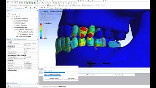 Webinar 9 - Skull and teeth 3D modelling and FEA simulations using ANSYS Workbench