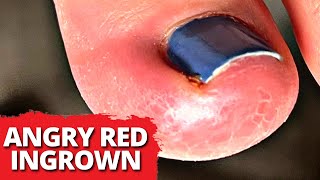 DEEP Red Ingrown Nail Removal