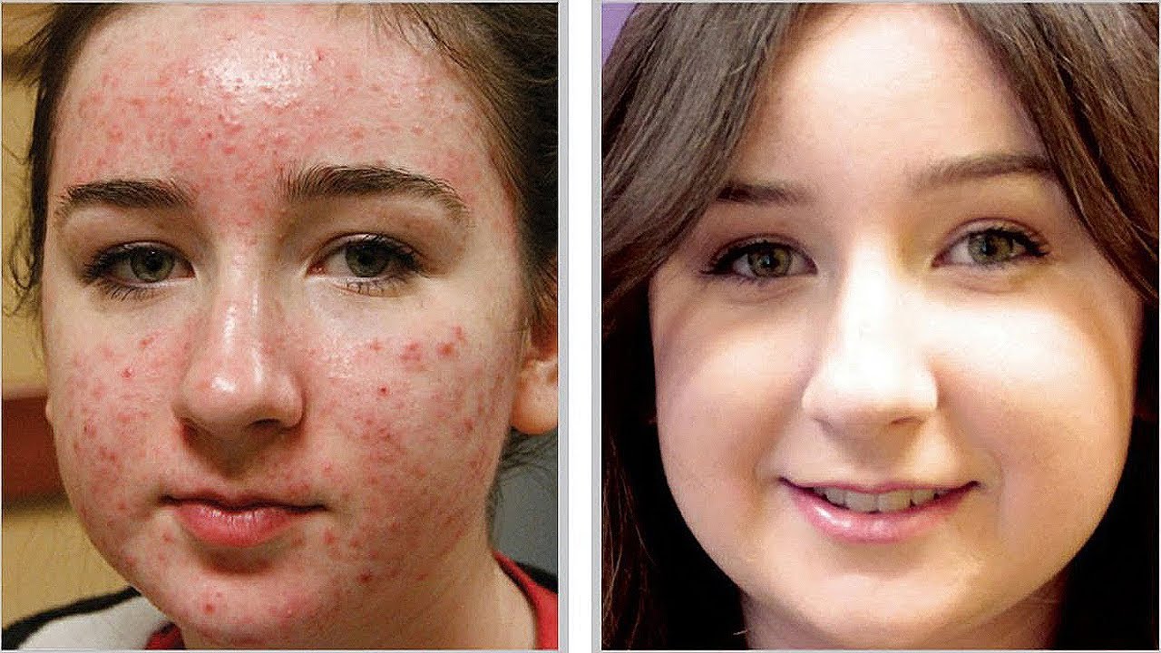 How To Get Rid Of Deep Acne Scars Fast Guaranteed Results Youtube