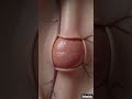 Painful Hemorrhoids