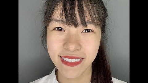 💖PHƯƠNG NGỌC - NIỀNG RĂNG MẮC CÀI KẾT HỢP BỌC SỨ💖