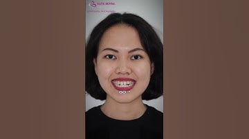 Niềng răng chữa lệch mặt, khớp cắn ngược #elitedental #niengrang