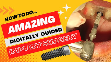 Amazing guided Implant surgery, flapless and fresh socket implant insertion with surgical guide