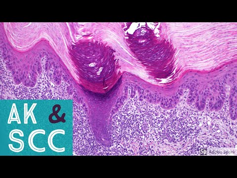 Squamous Cell Carcinoma & Actinic Keratosis 101...Dermpath Basics & Beyond