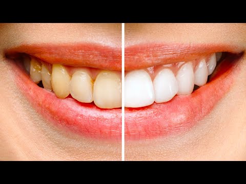 วีดีโอ: วิธีการ มีฟันขาวสะอาดเป็นมันเงา: 12 ขั้นตอน (พร้อมรูปภาพ)
