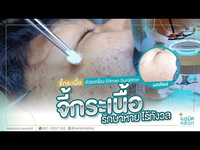 รีวิวตัดไฝ ขี้แมลงวัน EP.184/จี้กระเนื้อรักษาหายได้^^ @หมอปุ๊ NeramitClinic