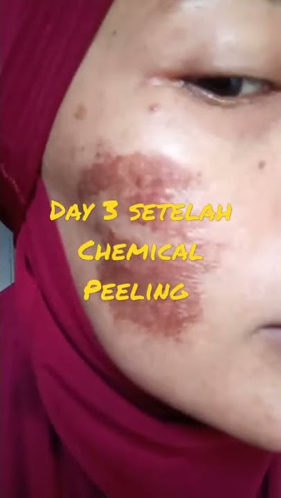 Chemical Peeling Menuju Kulit Mulus BeBas Flek