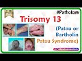 Trisomy 13 (Patau or Bartholin-Patau syndrome) - Causes , Diagnosis , Treatment