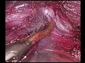 Dr  nilesh chordiya lap 3 field esophagectomy