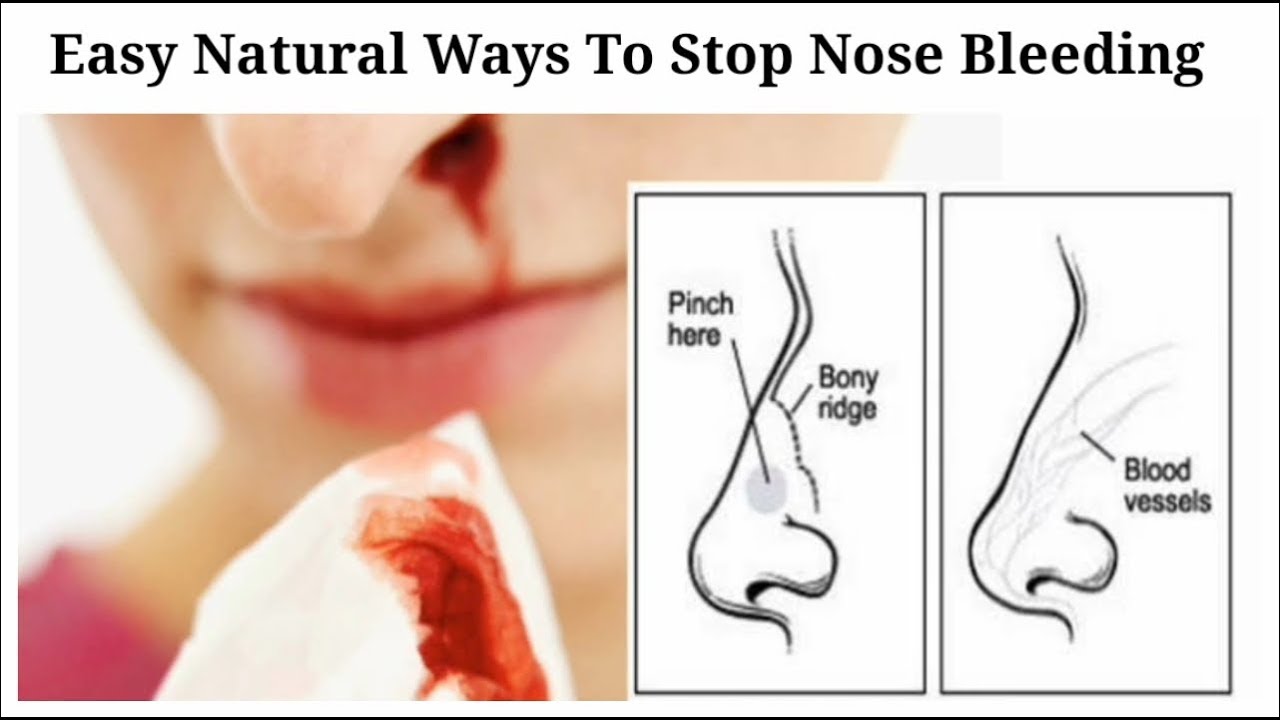 Bleeding, Natural Cures, Us, USA, Nose bleed, Nasal bleeding, Nose bleeding...