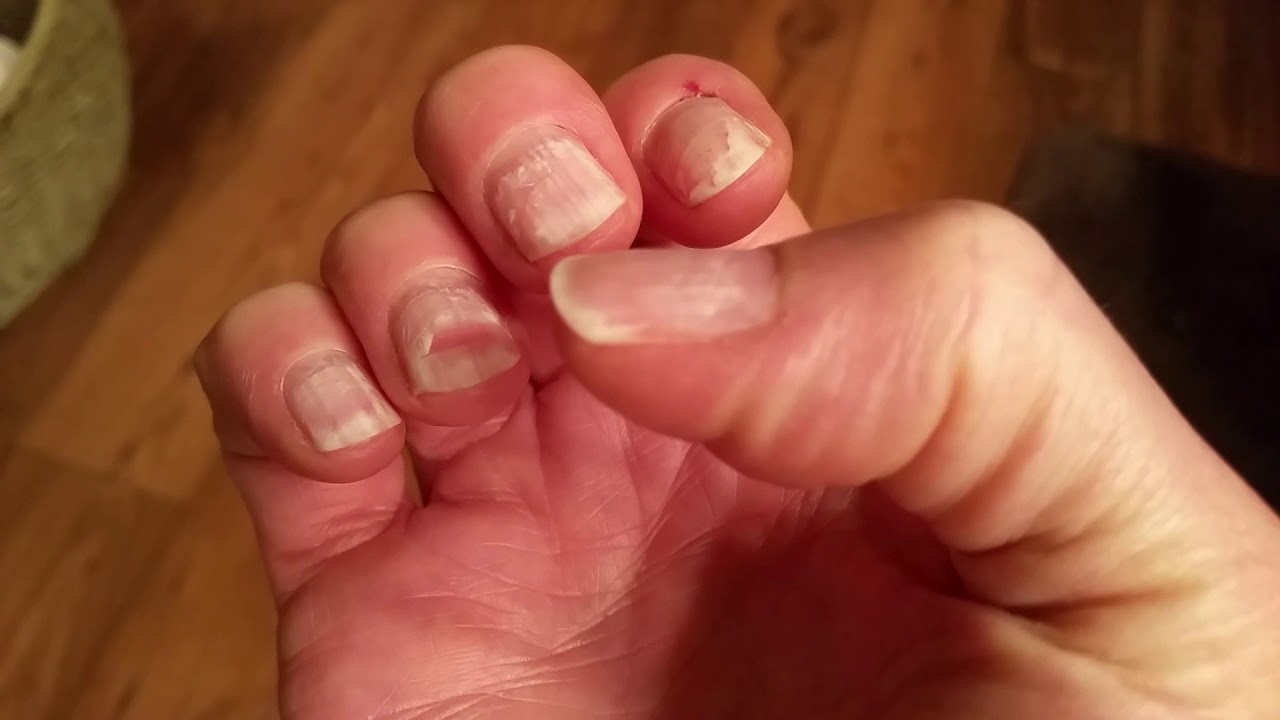 Severe Nail Damage from MMA Acrylics YouTube