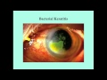 Keratitis - CRASH! Medical Review Series