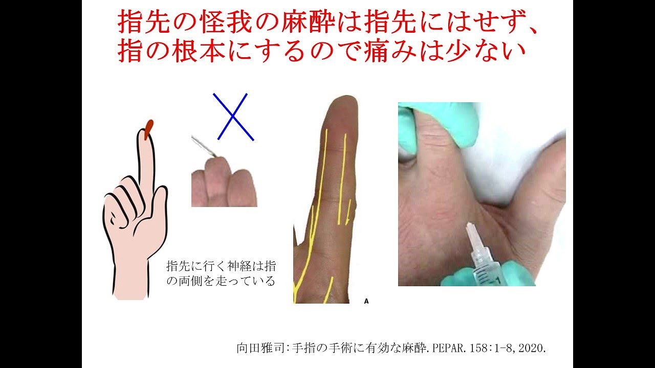 指の切り傷への麻酔は傷口に直接刺さないので安心して下さい。 - YouTube