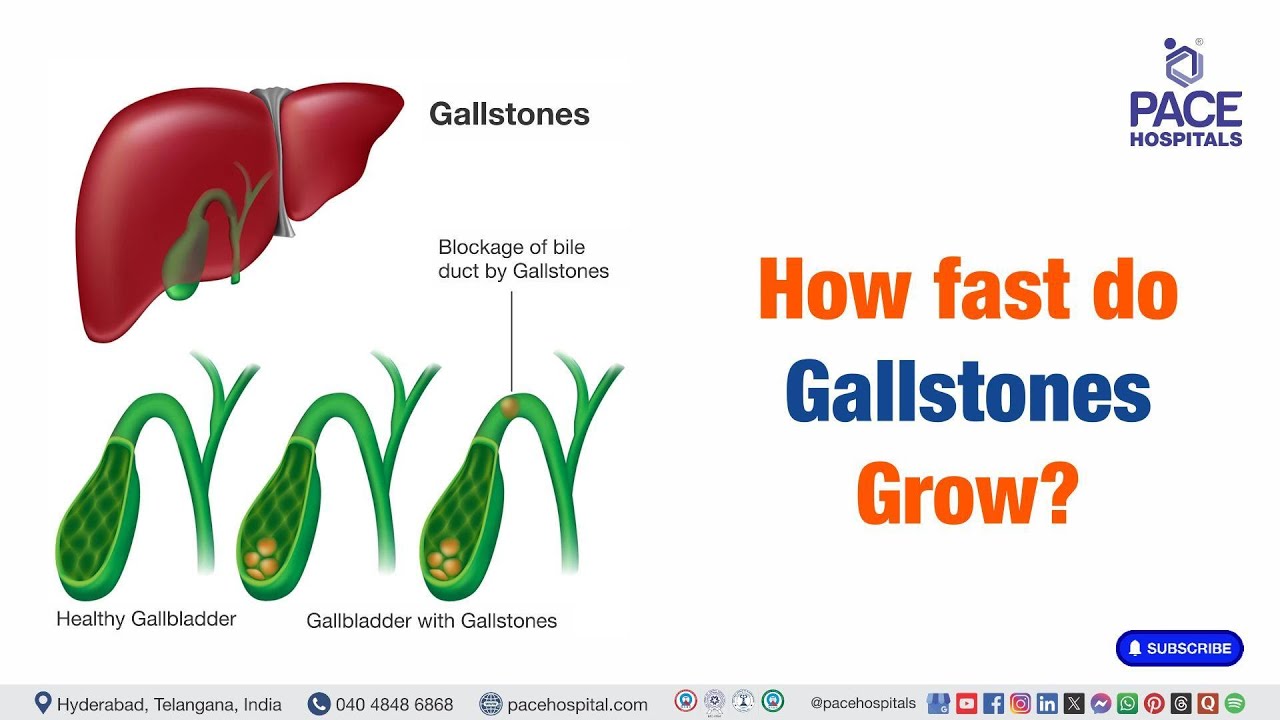 How Fast Do Gallstones Grow? | Progression Speed of Gallstone Formation 