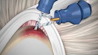 CONMED | Reparación de SLAP utilizando Anclaje de Sutura PressFT ™