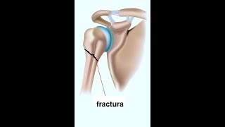 Fisioterapia 'Fractura de Humero'