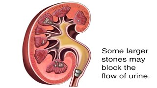 How Kidney Stones Are Formed Animation - Renal Calculi Causes & Symptoms Video - Blocked Urine Flow screenshot 5