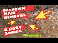Ingrown Hair Removal | 4 Part Series | #Episode 1