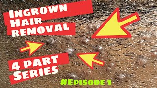 Ingrown Hair Removal | 4 Part Series | #Episode 1