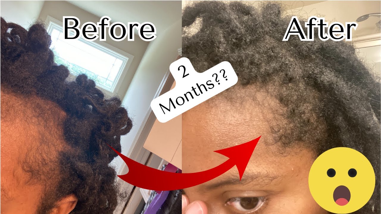 How I grew my edges back in 2 months | Postpartum Transformation - YouTube