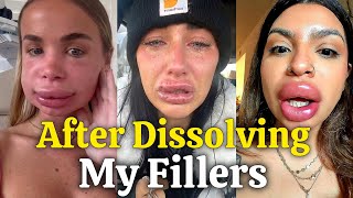 The Dark Side of Lip Filler Dissolving Nobody Talks About