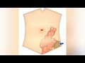 Diagnosis of pericolic abscess