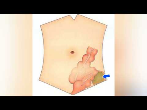 Diagnosis of pericolic abscess