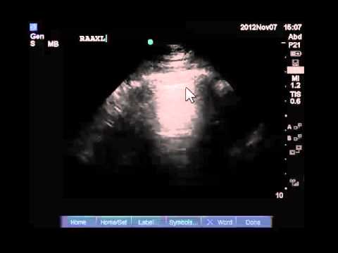 Image of Lung and Pleural Ultrasound: Acquisition Technique
