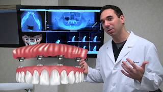 All on 4 Dental Implants Explained