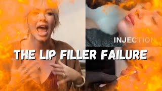 The Lip Filler Failure