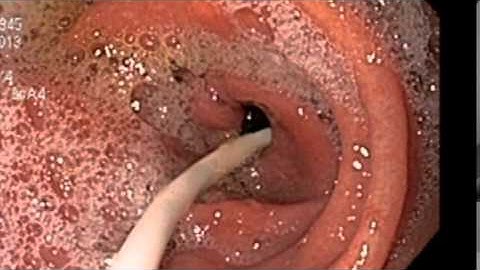 Colocación de Sonda Naso Yeyunal Guiada por Endoscopia