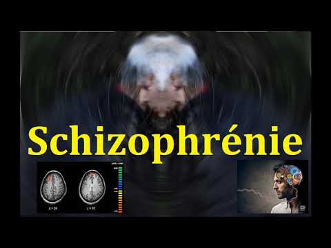 Schizophrénie les symptômes et la physiopathologie explication neurobiologique