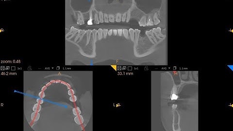 CBCT During the Live Surgical Patient Treatment Training of the Clinical Implantology Diploma