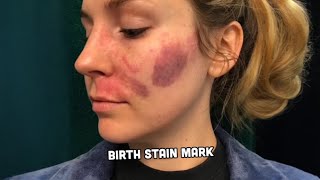 I Embrace My Port Wine Stain Birthmark ❤️ | Storytrender