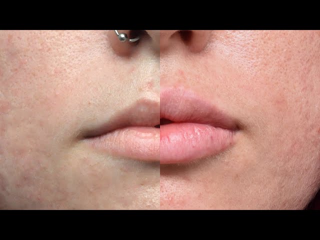 Savannah's Lip Filler Experience